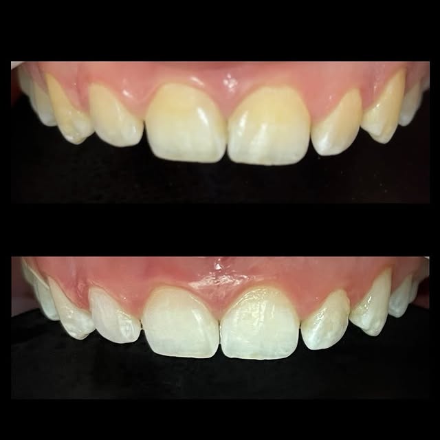 Caso de restauração estética — antes e depois